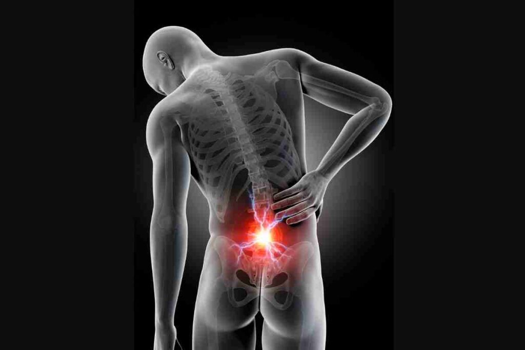 radiculopathy va rating
