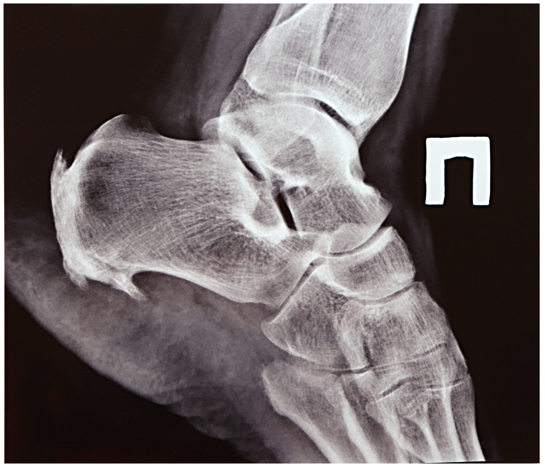 Featured image for “Plantar Fasciitis VA Ratings & Service Connection Guide”
